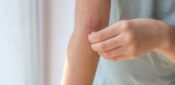 Mythbuster: ‘Everyone with eczema should be tested for allergy’