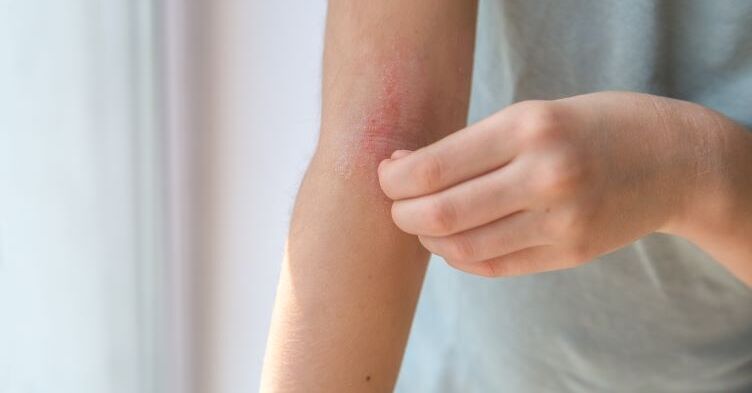 Mythbuster: ‘Everyone with eczema should be tested for allergy’