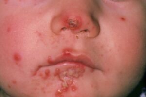 Case by case - managing common skin infections in primary care