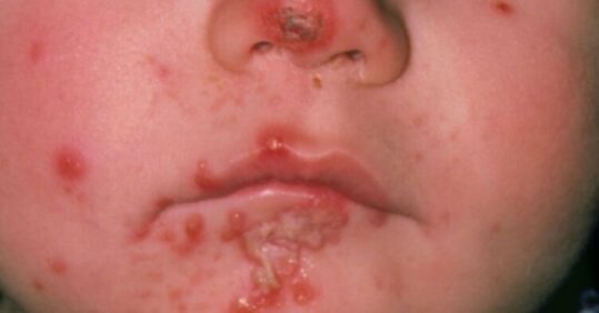 CPD: Case by case – managing common skin infections in primary care