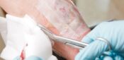 The role of larval therapy in wound care