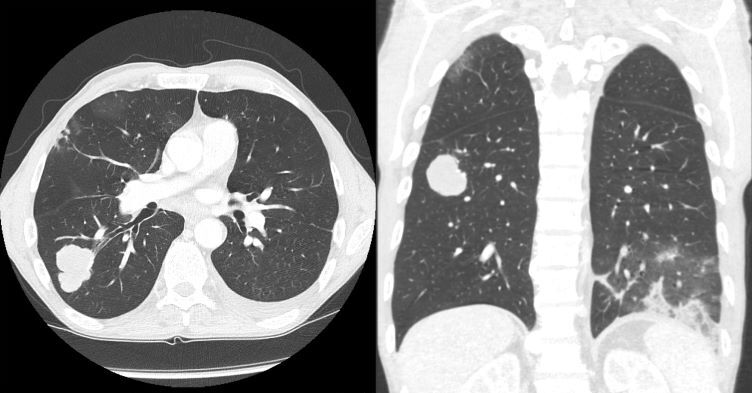 Supporting lung cancer screening in the community | Nursing in Practice