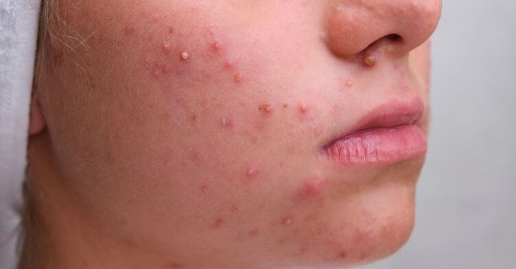 Top tips for supporting patients with acne  